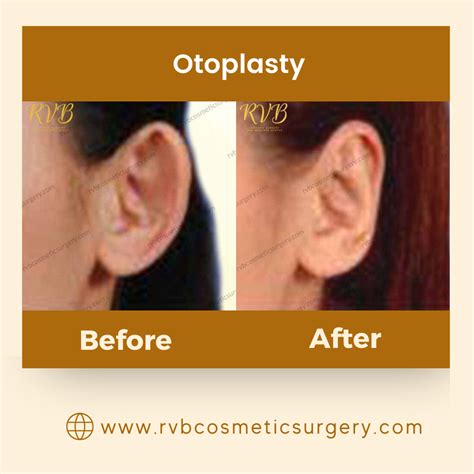 Otoplasty Philippines: Procedures, Candidates and .